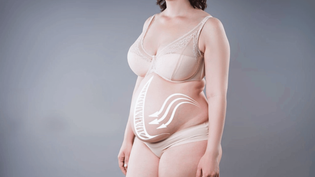 Femme en sous-vêtements beige, debout de profil avec un ventre post-partum arrondi. Des flèches dessinées sur son abdomen illustrent le diastasis des grands droits.
